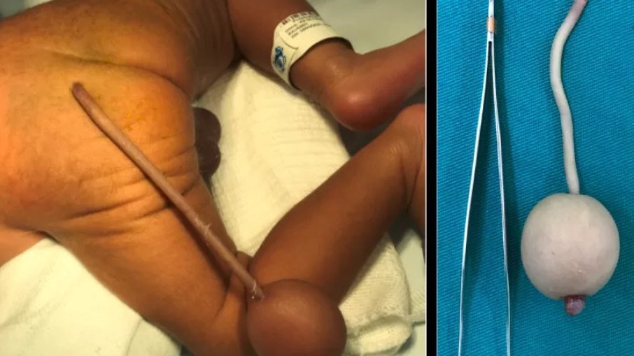 Bebê brasileiro nasce com cauda de 12 cm e bola de 4 cm na extremidade